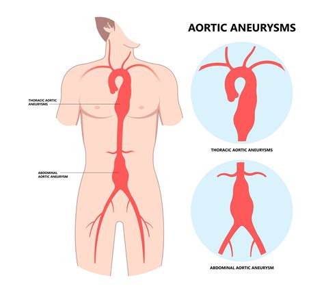 What is Aortic Root Dilatation? - Showit Blog