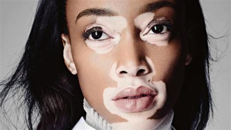 Vitiligo Skin Disease: All You Should Know About The Skin Disorder