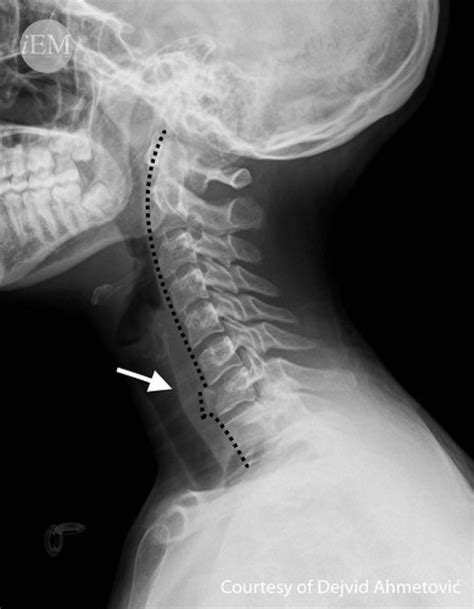 How to Read C-Spine X-Ray – International Emergency Medicine Education ...