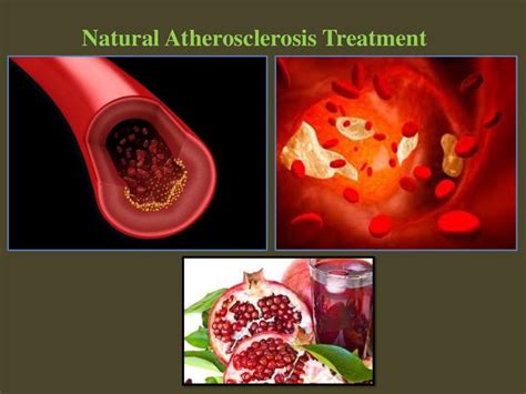 Natural Atherosclerosis Treatment