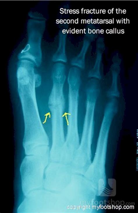 Metatarsal stress fracture | Treatment with a Spring Plate | MyFootShop.com