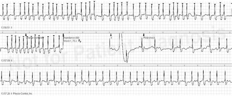 Successful electrical cardioversion of atrial fibrillation using ...