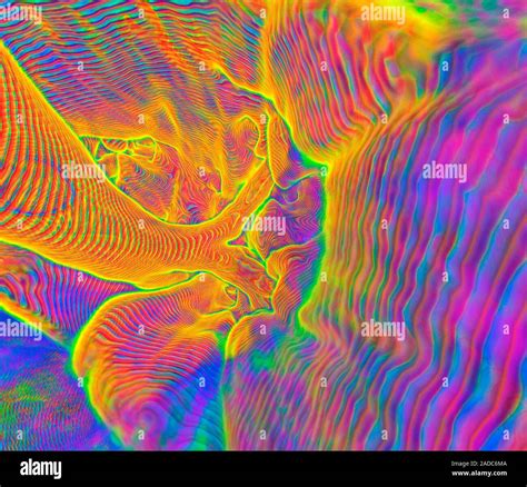 Hilum of the lung. Digitally enhanced 3D computed tomography (CT) scan ...