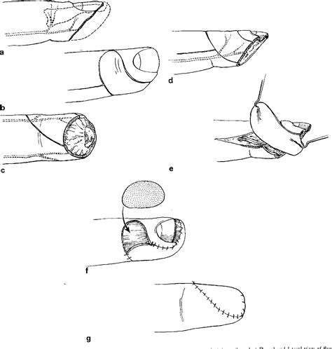 Figure 1 from A Neurovascular Island Flap for Volar-Oblique Fingertip ...