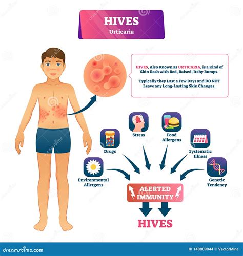 Urticaria Rash Causes