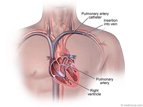 Pulmonary Artery Catheter