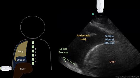 Pleural Effusion | teachIM | POCUS case