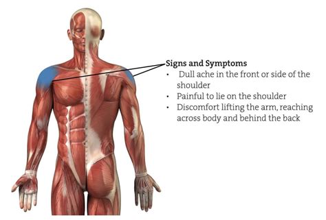 Shoulder Impingement Exercise - The Climbing Doctor