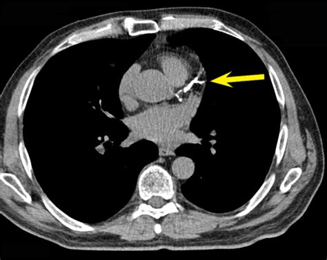 85% Coronary Artery Blockage found with NO SYMPTOMS – THE Q INSTITUTE