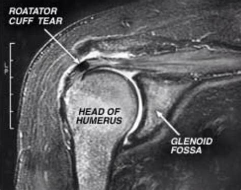 Shoulder rotator cuff tear MRI Unidad Especializada en Ortopedia y ...