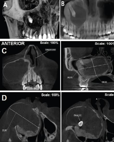 Adenomatoid Odontogenic Tumor