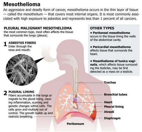 Malignant Mesothelioma | Malignant Mesothelioma treatment, prognosis ...