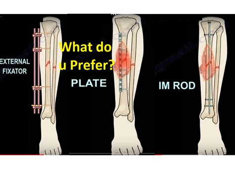 Open Fractures of the Tibia — OrthopaedicPrinciples.com