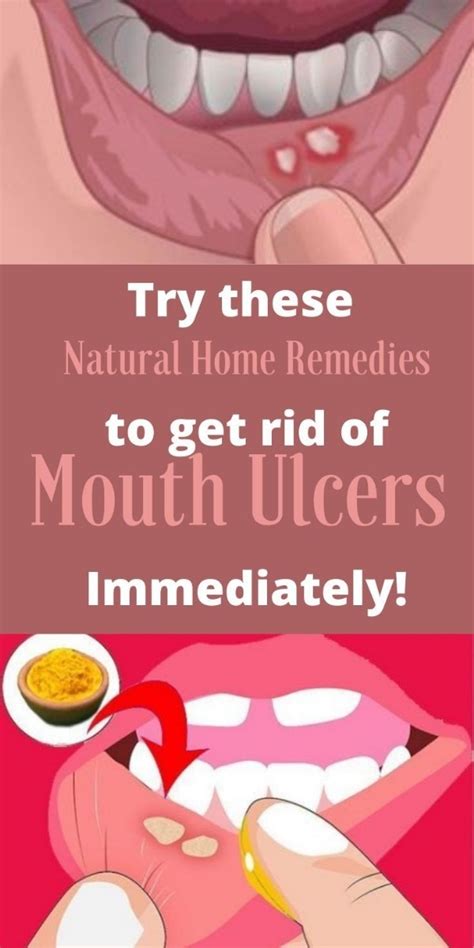 12 Natural Remedies for Mouth Sores that Work - NaturalRelieved