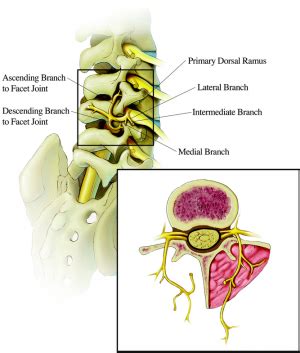 Lumbar Facet Syndrome - Physiopedia