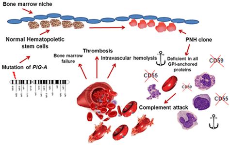 Paroxysmal Nocturnal Hemoglobinuria (PNH) Causes, 45% OFF