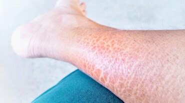 7 tips to treat skin problems due to diabetes | HealthShots