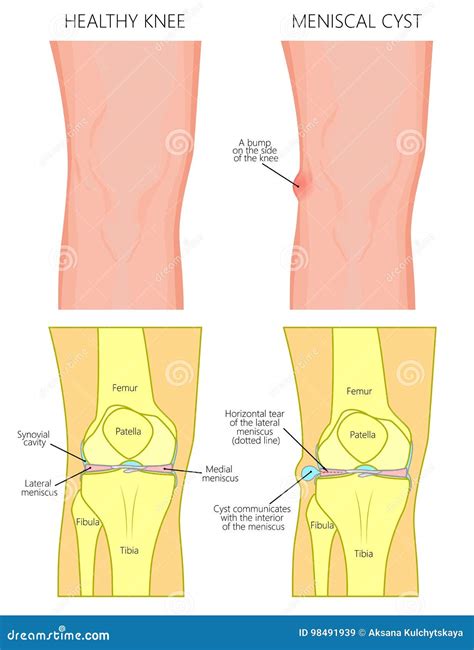 Meniscus _Meniscal Cyst Front View Cartoon Vector | CartoonDealer.com ...