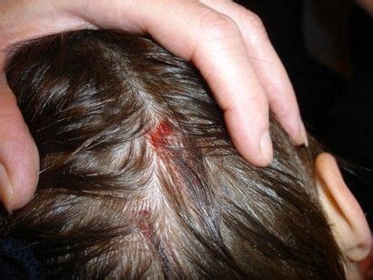 The pimples on your scalp can be caused by a variety of conditions and ...