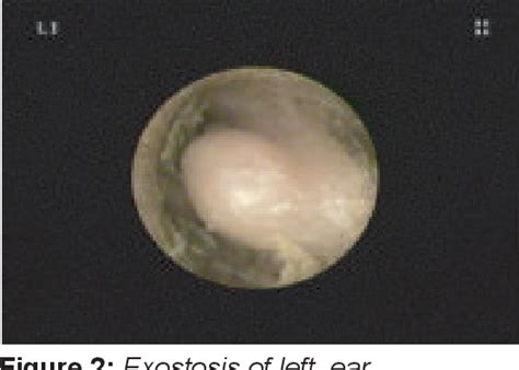 Figure 2 from Exostoses of the external auditory canal | Semantic Scholar