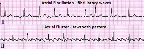 Atrial Fibrillation Topic Review | LearntheHeart.com