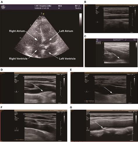 Color Doppler ultrasonography of the neck and heart was performed in 6 ...