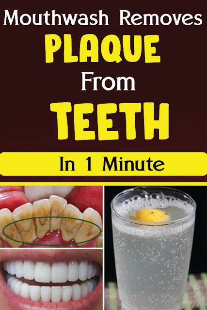 Mouthwash Removes Plaque From Teeth In 1 Minute