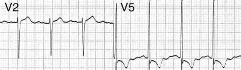 Left Ventricular Hypertrophy (LVH) • LITFL • ECG Library Diagnosis