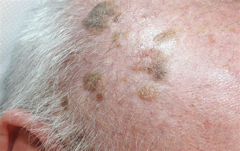 Seborrheic Keratosis (Senile Warts) Removal - Altrincham, Manchester