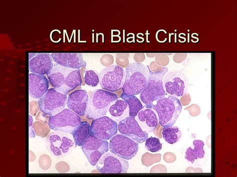 Myeloproliferative disorders