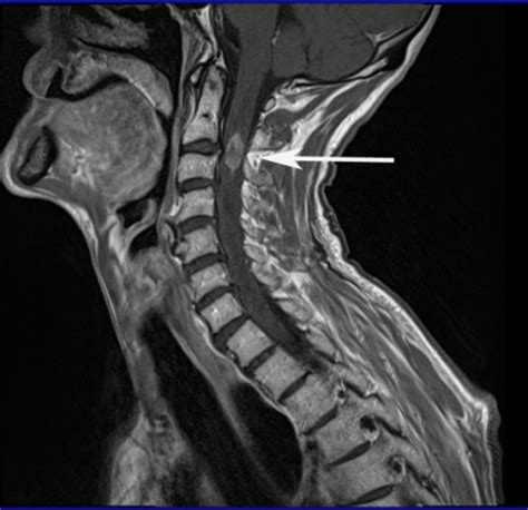 cervical spine mri with contrast Car Tuning