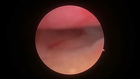 HYSTEROSCOPIC POLYPECTOMY 12.11.2022 - YouTube