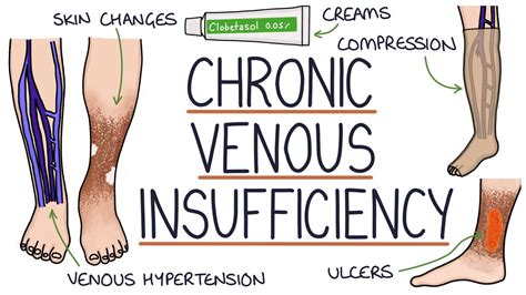 Understanding Chronic Venous Insufficiency - YouTube