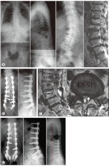 Surgical Treatment of Adult Degenerative Scoliosis – ScienceOpen