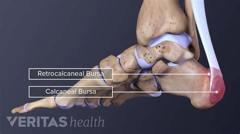 Subcutaneous Calcaneal Bursitis