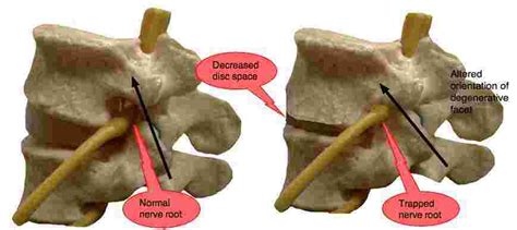 Lumbar facet arthropathy causes lower back and leg pain on extension.