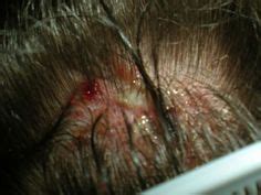 8 Best Sores on Scalp ideas | sores on scalp, scalps, soreness