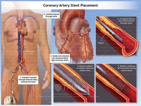 Coronary Artery Stent Placement - TrialQuest Inc.