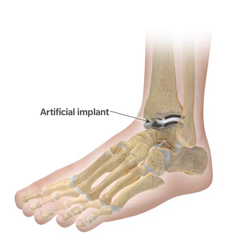 What to Expect During Total Ankle Replacement Surgery