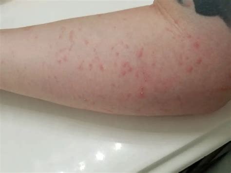 hives on my arm - Allergy Preventions