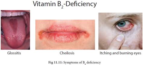 Vitamin B2 (Riboflavin) : Functions, Food Sources, Symptoms of deficiency