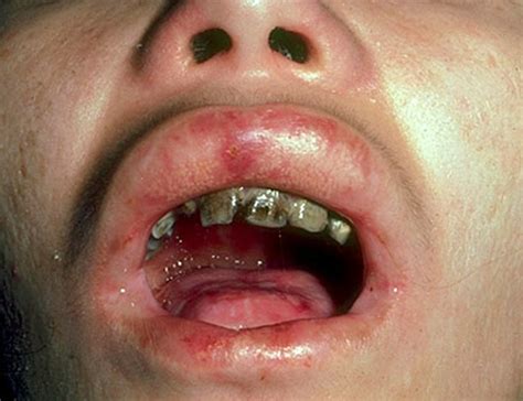 👉 Epidermolysis Bullosa - Pictures, Life Expectancy, Treatment ...