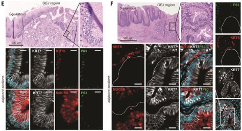 Groundbreaking Study on How Barrett's Esophagus becomes Cancer ...