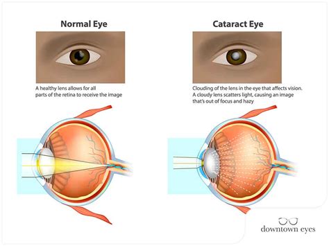 Everything You Should Know About Preventing Cataracts - Downtown Eyes