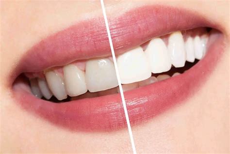 When Little Things Mean A Lot: The Pros and Cons of Teeth Whitening ...