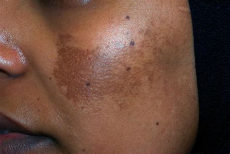 Causes of Melasma and How to Treat It