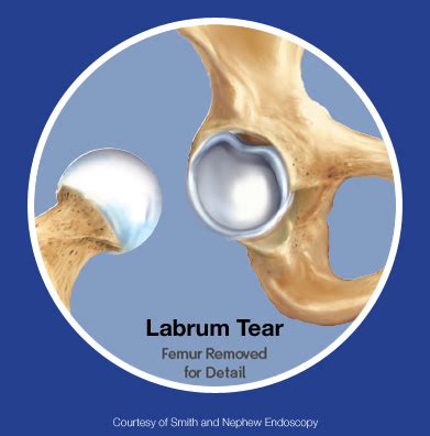 Acetabular Labrum Tear | Hip Arthroscopy | Georgia | Atlanta