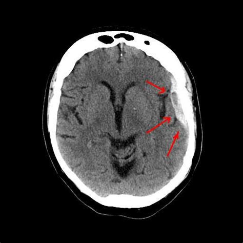 Subdural hematoma | Mechanism, Symptoms, & Management | Britannica