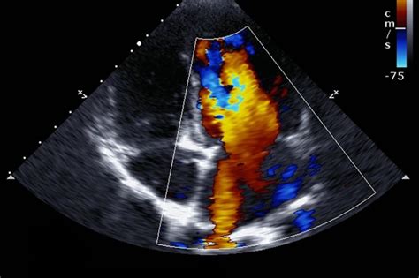 Echocardiogram: What You Need to Know | UPMC HealthBeat