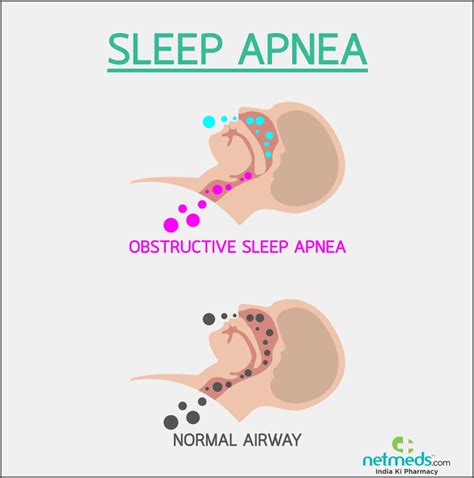 Obstructive Sleep Apnea: Causes, Symptoms And Treatment